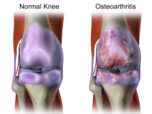 normal knee vs osteoarthritis